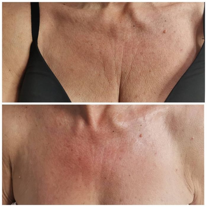 peeling quimico dina dascal